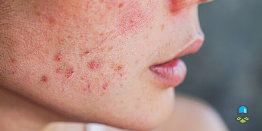 چگونه از جوش قبل از قاعدگی پیشگیری کنیم؟